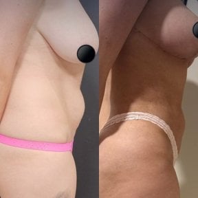 before-after photo 360-liposuction
