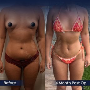 before-after photo 360-liposuction