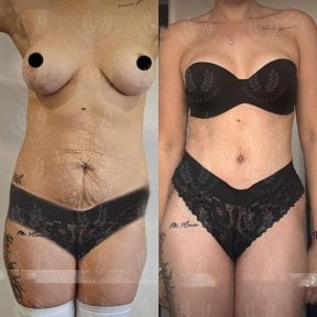 before-after photo 360-liposuction