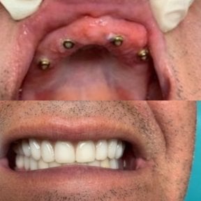 before-after photo protezirovanie-zubov
