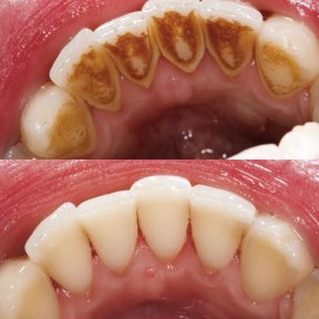 before-after photo deep-cleaning-scaling-and-root-planing