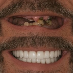 before-after photo implantacia-zuba