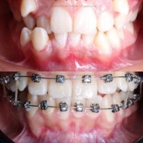 before-after photo breket-sistema