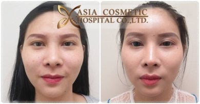 before-after photo forehead-augmentation-implant