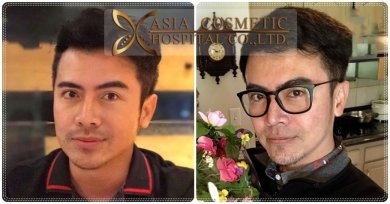 before-after photo chin-implants