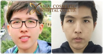 before-after photo chin-implants