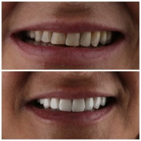 before-after photo emax-veneers