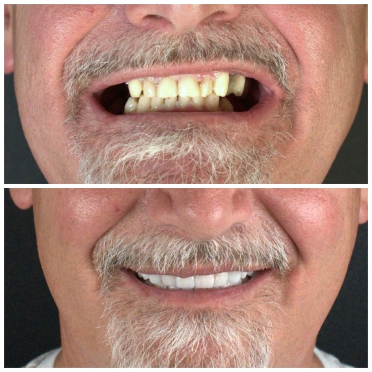 Resultados antes y después de carillas Emax en SUAVE DENTAL CLINIC – sonrisa renovada
