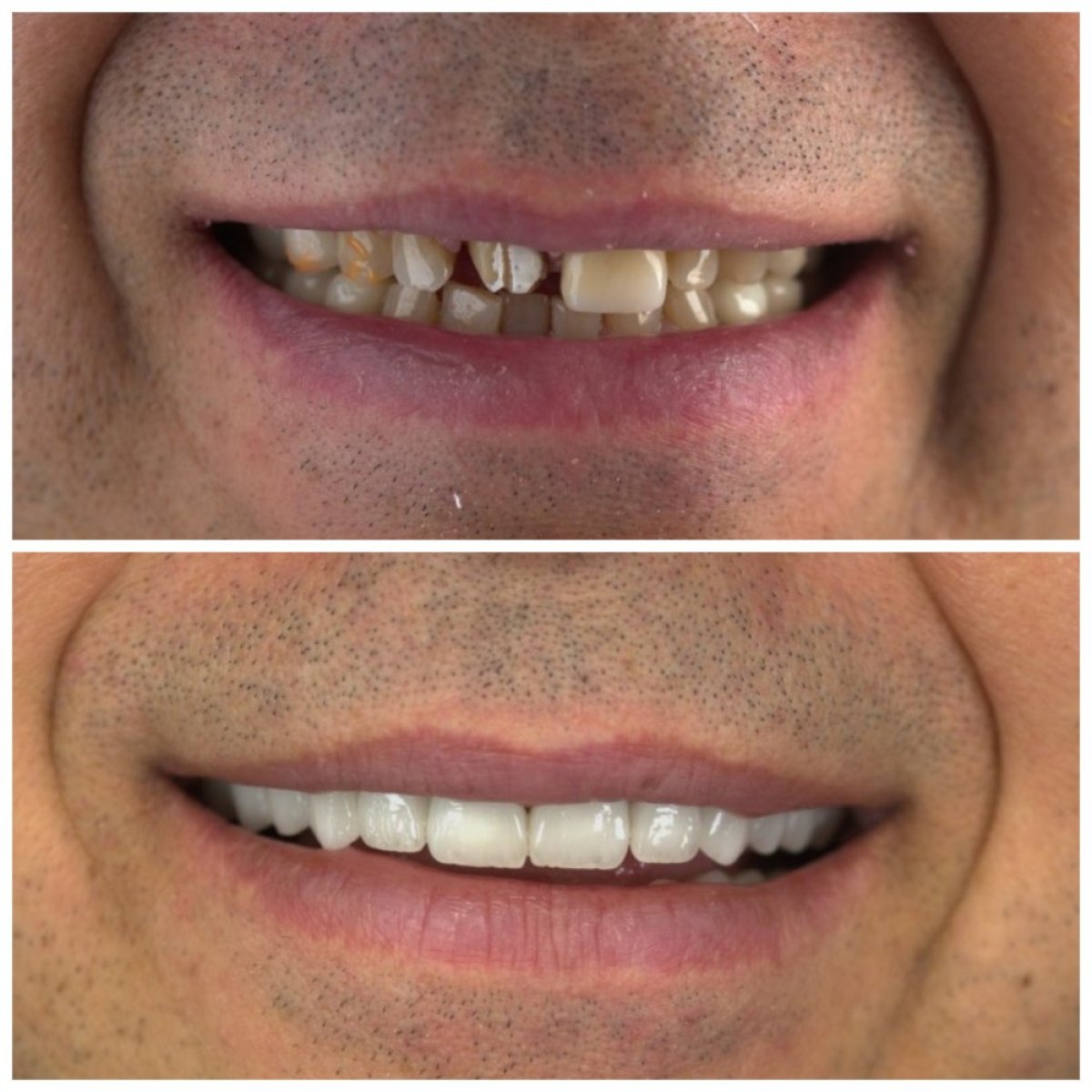 قبل وبعد الفينير في SUAVE DENTAL CLINIC، ابتسامة طبيعية النتائج