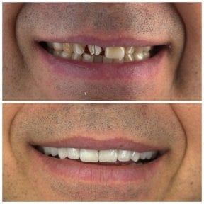 before-after photo installation-of-a-veneer