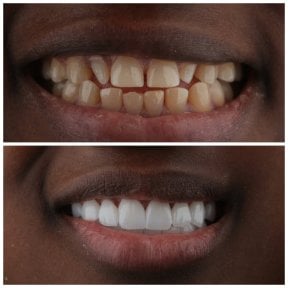 before-after photo installation-of-a-veneer
