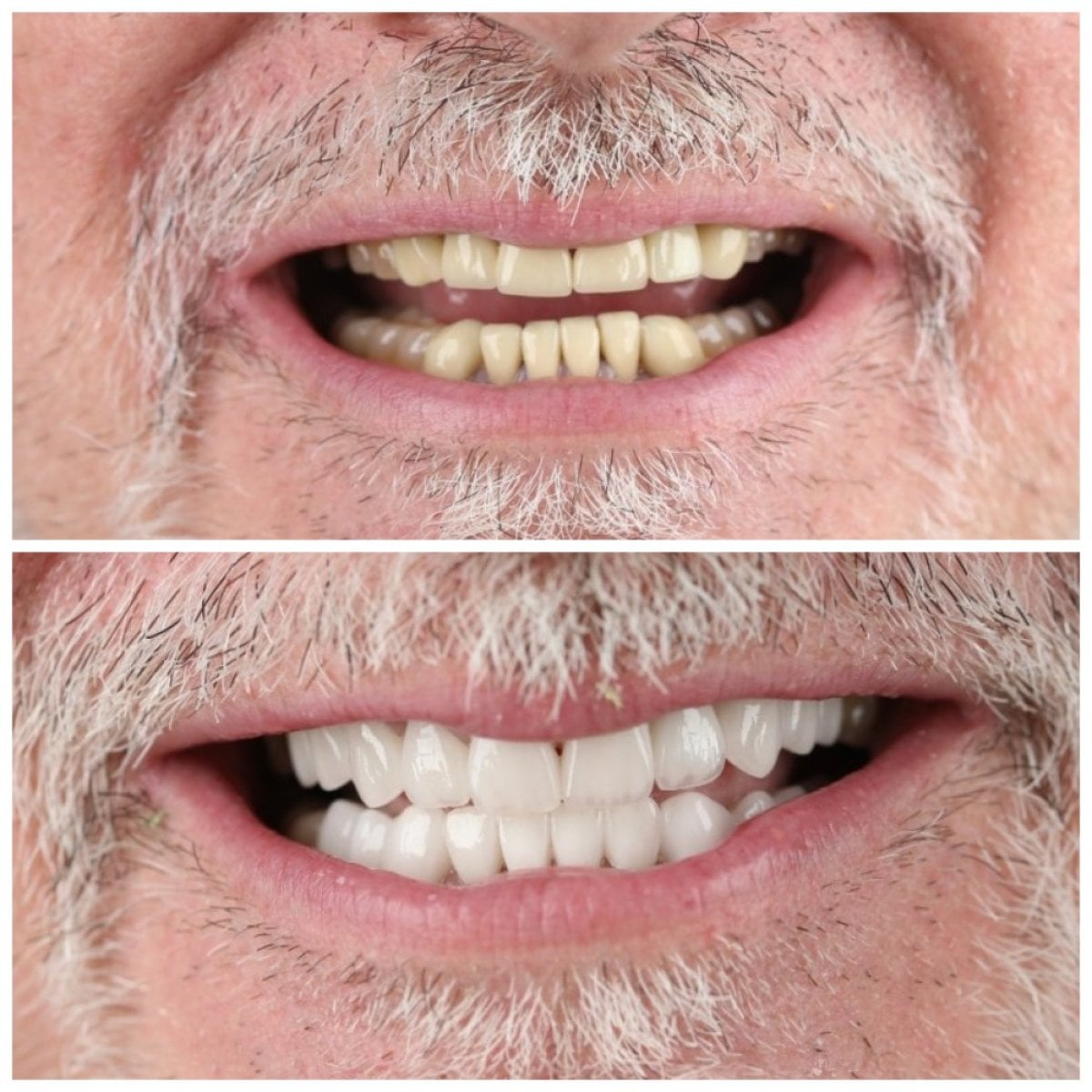 Antes y después de carillas dentales en SUAVE DENTAL CLINIC – sonrisa natural