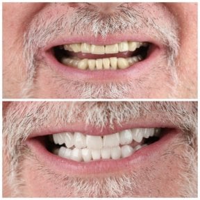 before-after photo installation-of-a-veneer