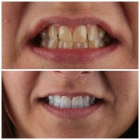 before-after photo installation-of-a-veneer