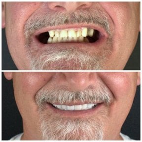 before-after photo installation-of-a-veneer