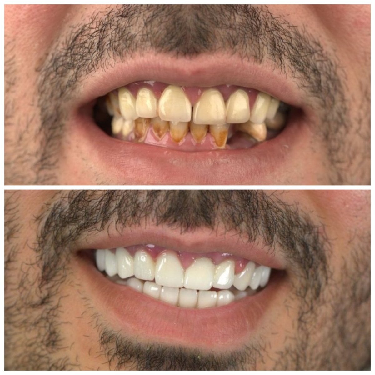نتائج قبل وبعد الفينير في SUAVE DENTAL CLINIC، تحول الابتسامة بنتائج طبيعية