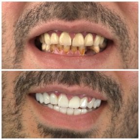 before-after photo installation-of-a-veneer