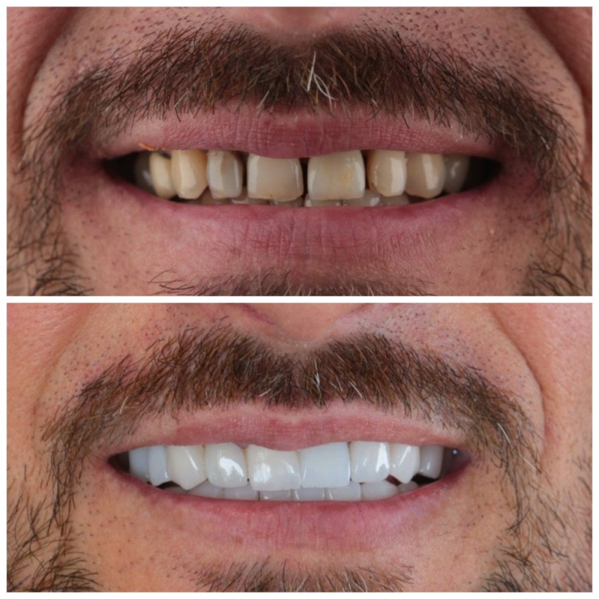 Antes y después de carillas Emax en SUAVE DENTAL CLINIC, sonrisa natural mejorada