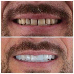 before-after photo emax-veneers