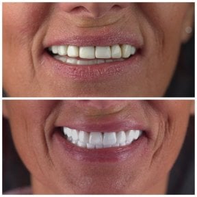 before-after photo emax-veneers