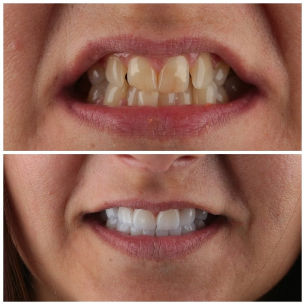قبل وبعد قشور إيماكس في SUAVE DENTAL CLINIC، نتيجة تحول الابتسامة