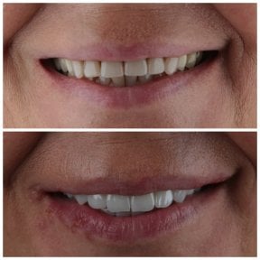 before-after photo emax-veneers