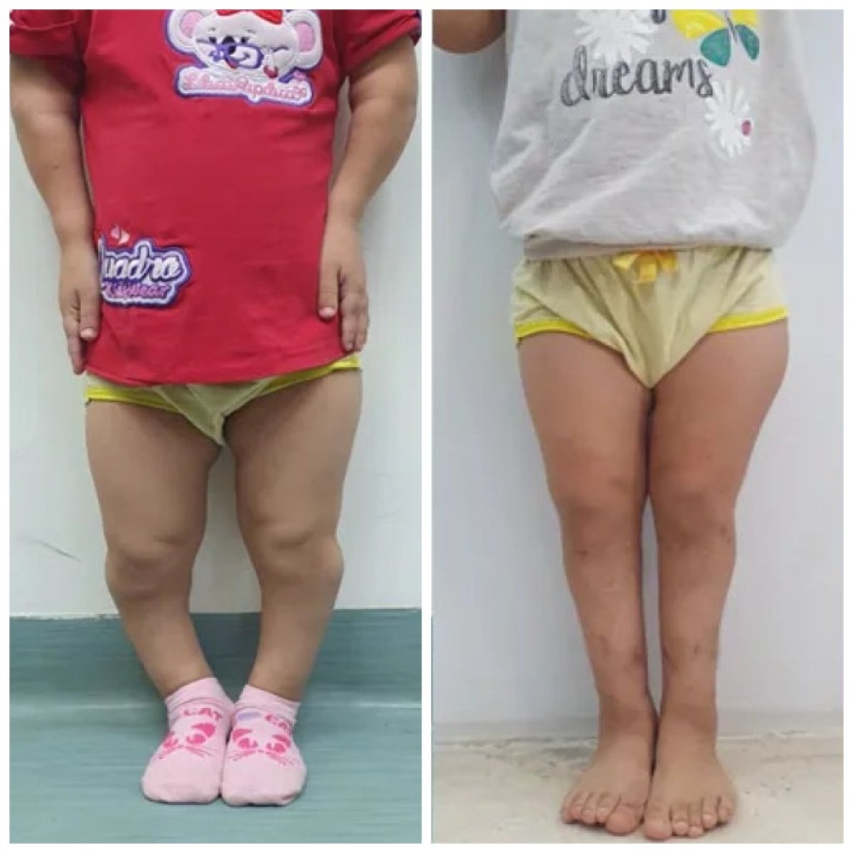 Resultados de alargamiento de extremidades en niño: mejor alineación de piernas