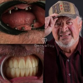 Résultats avant/après implants dentaires à DentaRay Clinic – restauration complète de la bouche