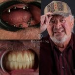 Résultats avant/après implants dentaires à DentaRay Clinic – restauration complète de la bouche