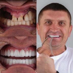 Результаты до и после имплантации зубов в DentaRay Clinic – восстановленная улыбка