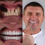 Результаты до и после имплантации зубов в DentaRay Clinic – восстановленная улыбка