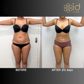 before-after photo bodytite-body-contouring