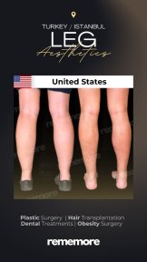 Before and after leg aesthetics results at Memorial Göztepe Hospital, improved leg contour