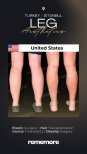 Before and after leg aesthetics results at Memorial Göztepe Hospital, improved leg contour