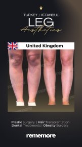 Before and after leg liposuction results at Memorial Göztepe Hospital, improved leg contour