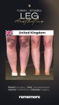 Before and after leg liposuction results at Memorial Göztepe Hospital, improved leg contour