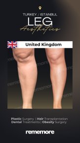 Before and after liposuction results at Memorial Göztepe Hospital, improved leg contour
