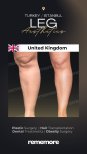 Before and after liposuction results at Memorial Göztepe Hospital, improved leg contour