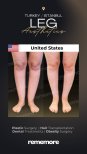Before and after liposuction results on legs at Memorial Göztepe Hospital, improved contour