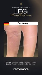 Before and after liposuction results on legs at Memorial Göztepe Hospital, smoother contours