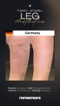 Before and after liposuction results on legs at Memorial Göztepe Hospital, smoother contours