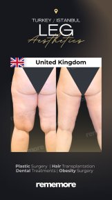 Before and after liposuction results at Memorial Göztepe Hospital, improved leg contour
