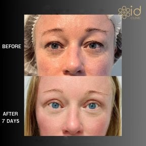 before-after photo blepharoplasty-eyelid