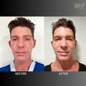before-after photo tightening-of-facial-skin-facelift