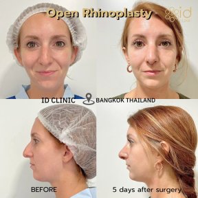 before-after photo rhinoplasty-nose-job