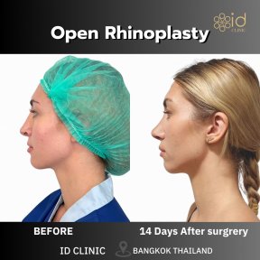before-after photo rhinoplasty-nose-job