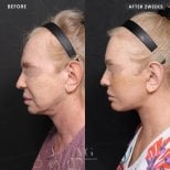 Результаты до и после deep plane SMAS-лифтинга в VG Plastic Surgery, омоложение лица