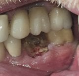 Результат до процедури тимчасового зубного мосту в SoftDentalCare Clinic, відсутній зуб