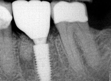 Рентген результат встановлення тимчасового зубного мосту в SoftDentalCare Clinic, видно імплант