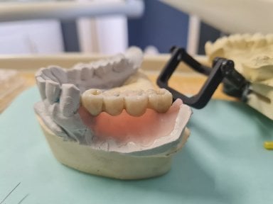 Результат тимчасового зубного мосту в SoftDentalCare Clinic, відновлення відсутніх зубів